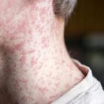 Penyakit campak (ilustrasi).